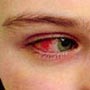 Pink eye... Conjunctivitis has arrived